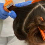 The Nit-Picking Dilemma: Pros And Cons Of Manual Lice Removal