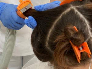 The Nit-Picking Dilemma: Pros And Cons Of Manual Lice Removal
