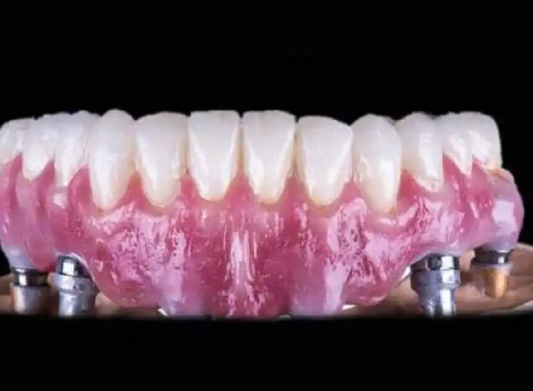What Happens If A Dental Implant Fails And How To Fix It